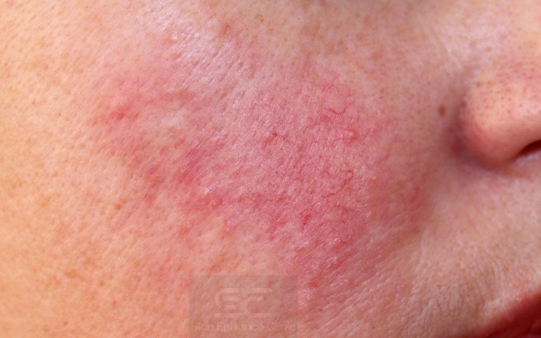 Could the sensitivity on your face be Rosacea?