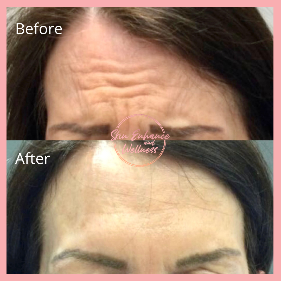 Anti wrinkle injections