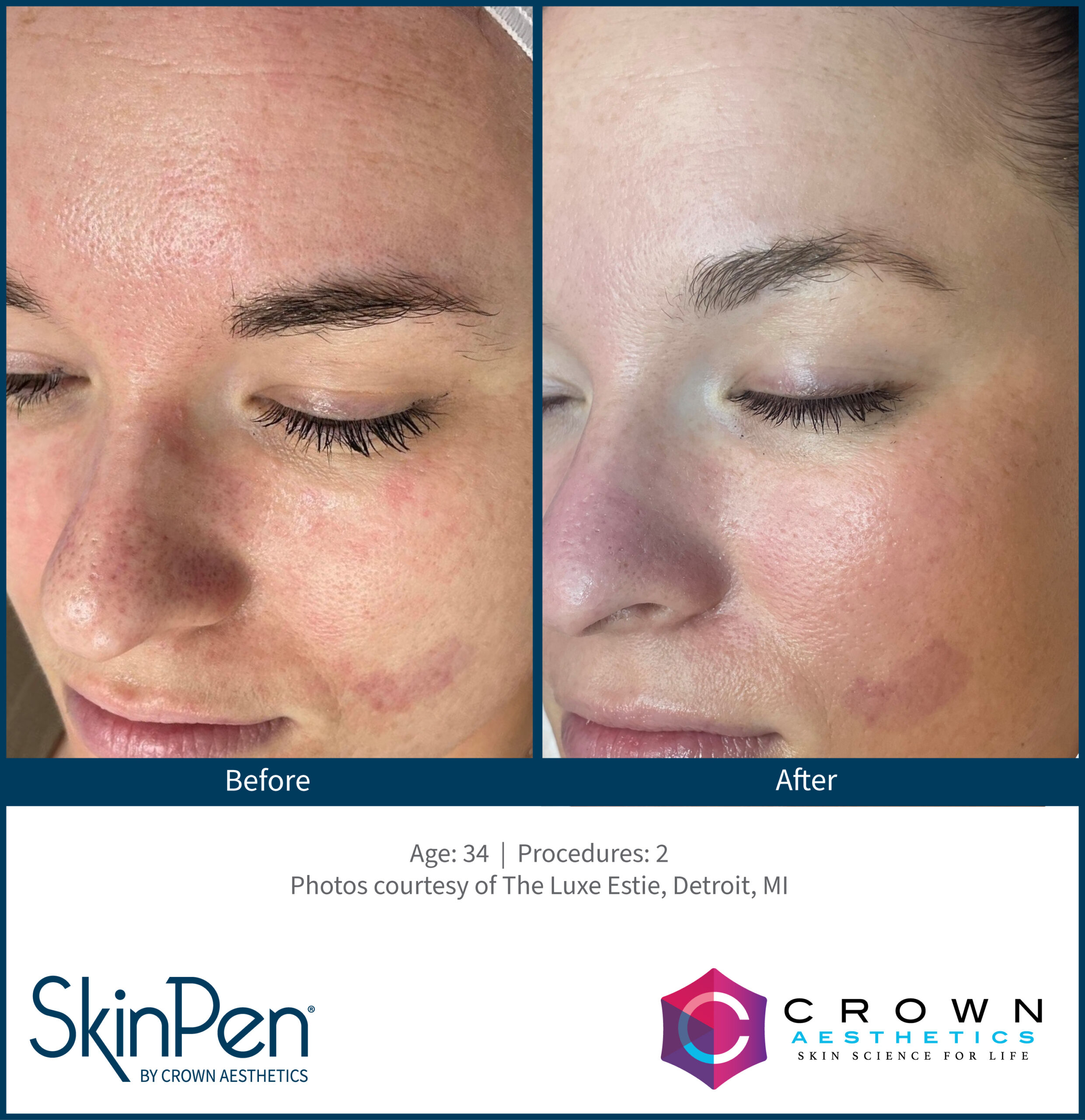SkinPen Before and after